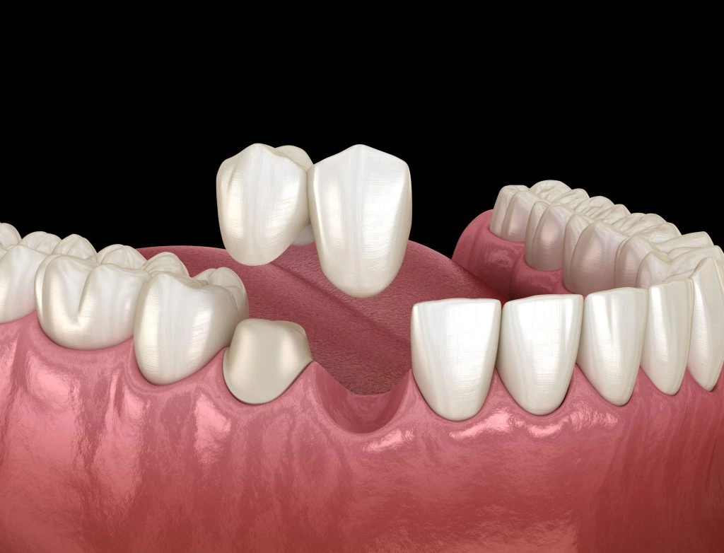 Fixed dental bridge for missing tooth replacement Illustration of a fixed dental bridge replacing a missing tooth at Smile Studio Dental, Markham