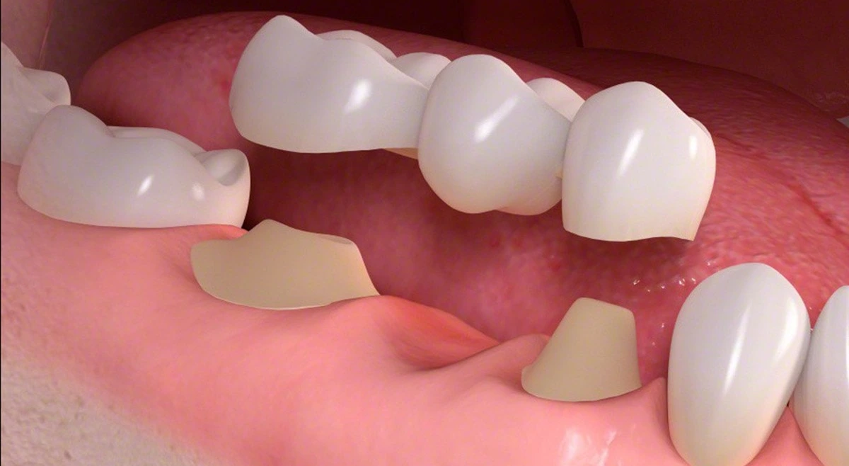 Fixed dental bridge for missing tooth replacement Illustration of a fixed dental bridge replacing missing teeth